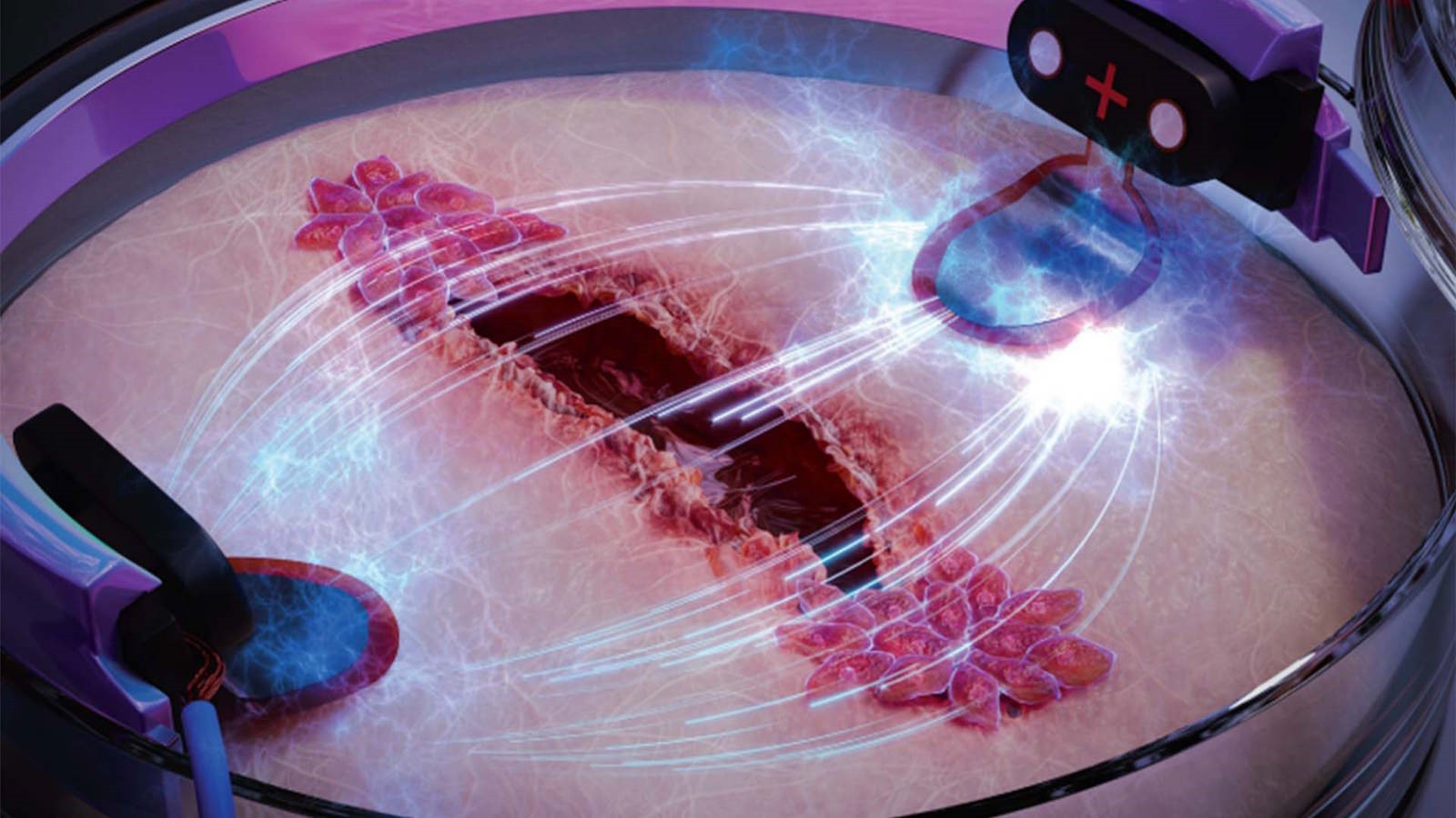Cicatrisation d'une blessure via l'électricité.